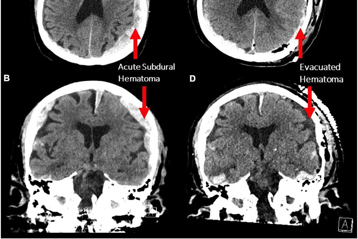 La vida pasa efectivamente ante nuestros ojos antes de morir: descubren que el cerebro desata un "recuerdo de la vida" antes de la muerte